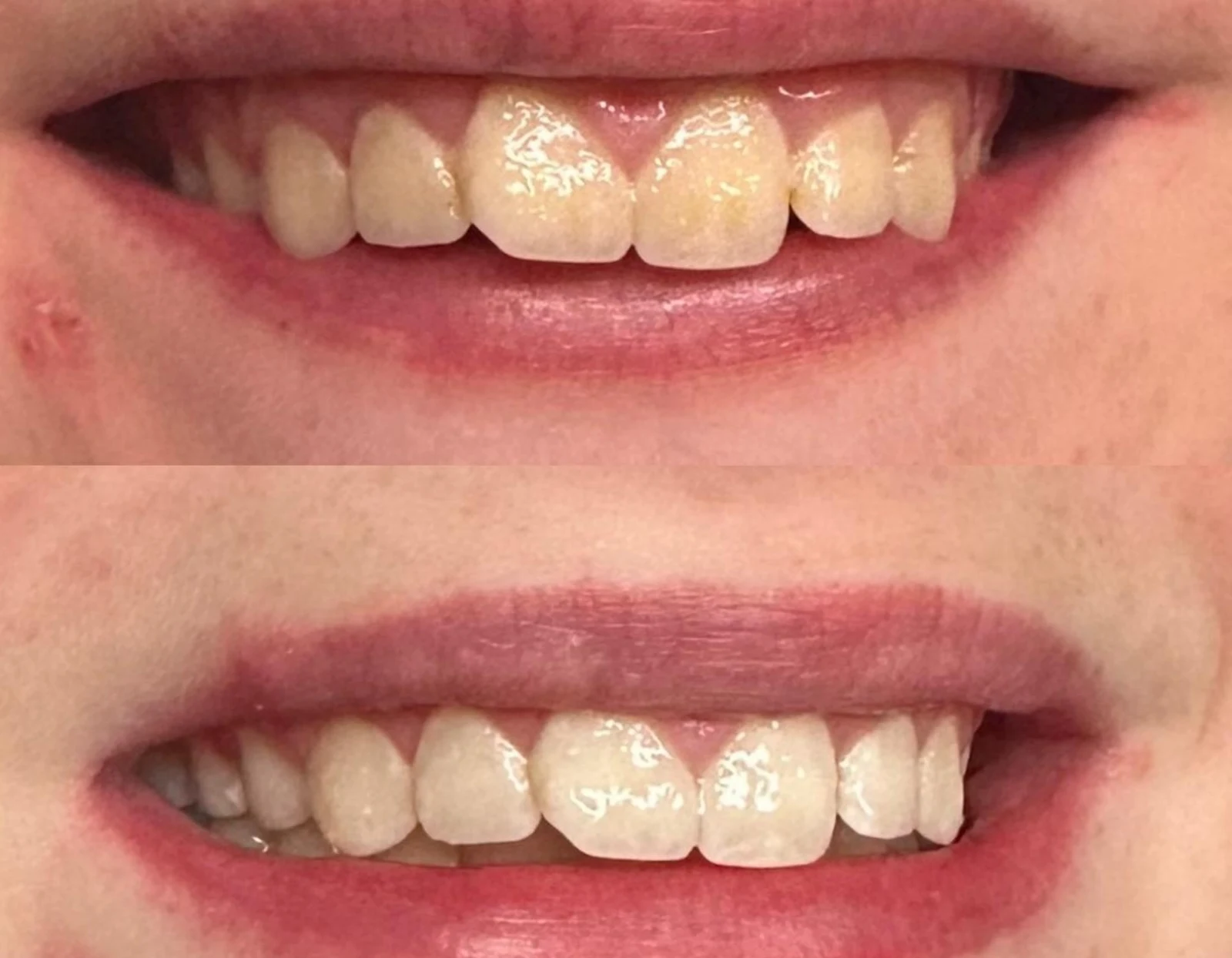 Teeth whitening before and after
